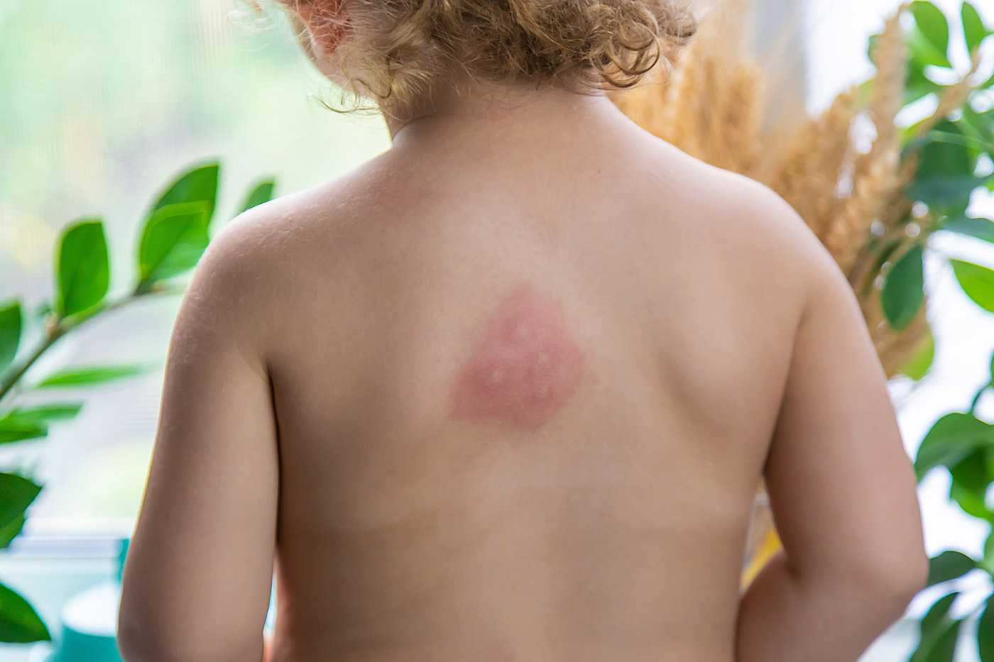 Enfant avec une piqure de moustique.